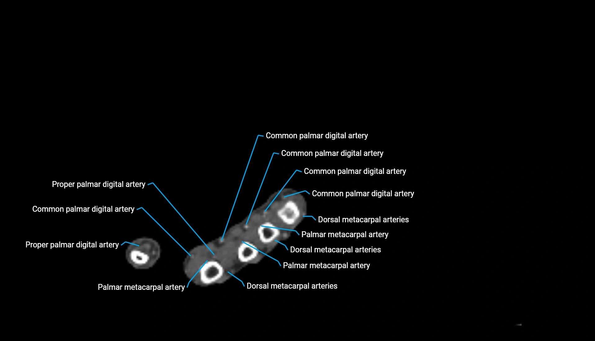 CTA upper limb axial cross sectional anatomy labelled image 50 (2).webp